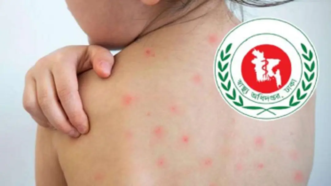 দেশে হামের প্রকোপ বৃদ্ধি: গত ২৪ ঘণ্টায় ৪ শিশুর মৃত্যু, আক্রান্ত সহস্রাধিক